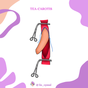 Lernskript- TEA- Carotis